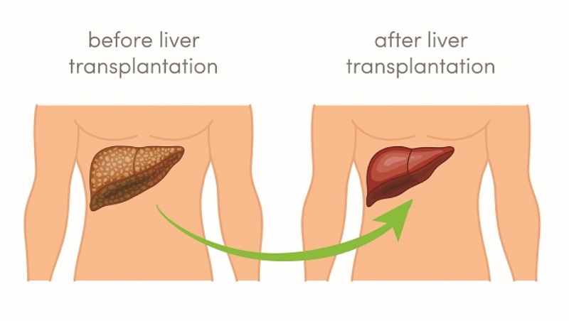 Ilustrasi transplantasi hati. (Foto: Repro)